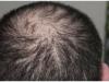 This new drug could cure baldness: study