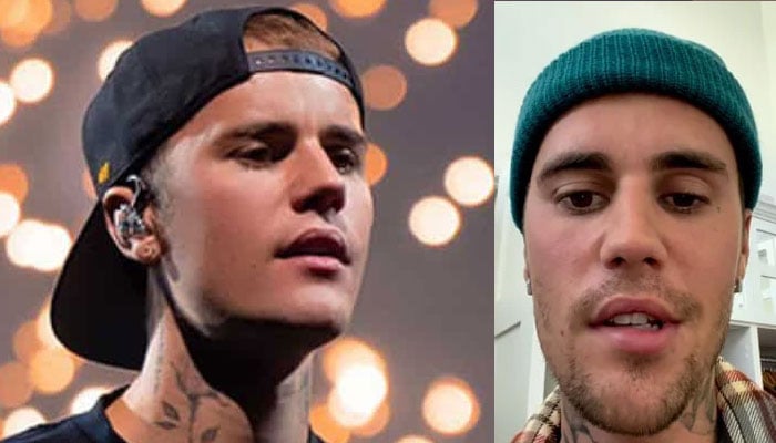 Ekspert vurderer Justin Biebers ansigtsterapi for Ramsay Hunt-syndrom
