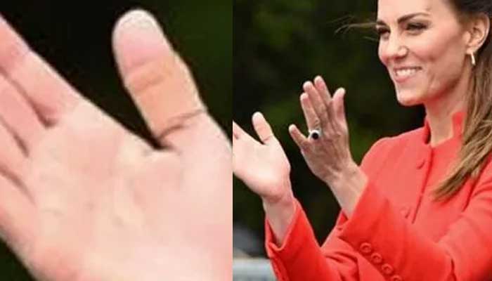 Kate Middletons plastered thumb sparks speculations