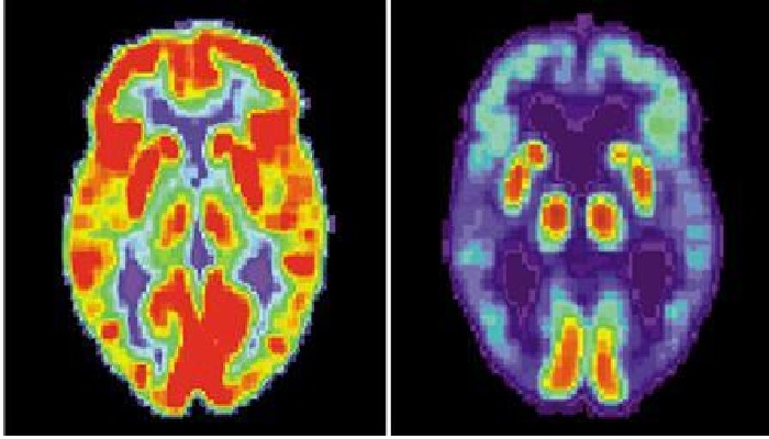 A split-view image showing PET scans of a normal brain (L) and a brain with Alzheimers disease. —Reuters
