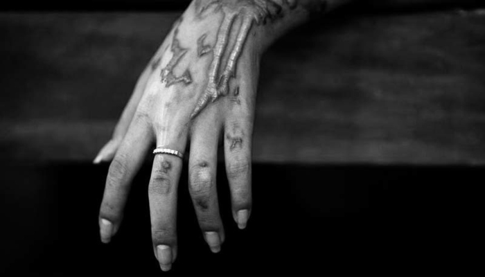 An acid attack survivor shows burn scars on her hand. — Reuters