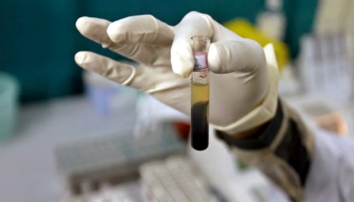 A laboratory assistant examines a blood sample. Photo by: REUTERS / Rupak De Chowdhuri