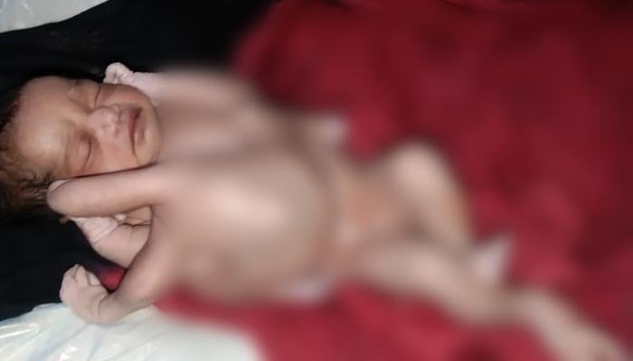 Baby born with four arms, legs hailed as 'miracle of nature' 11 The picture shows a baby born with multiple limbs. — India Today