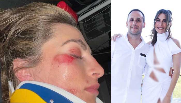 Pacar Michael Rubin, Camille Fishel, dirawat di rumah sakit setelah tanam wajah di pesta 4 Juli yang bertabur bintang