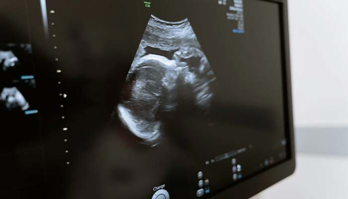 33 women receive uterus transplants in the US.— Pexel