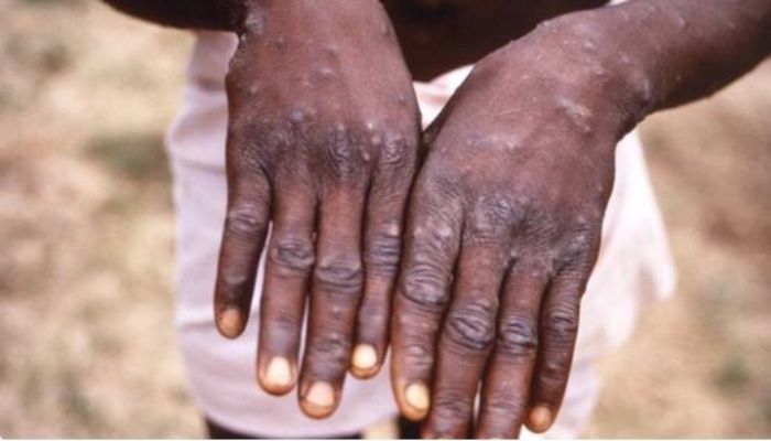 First case of monkeypox reported in Indian - AFP