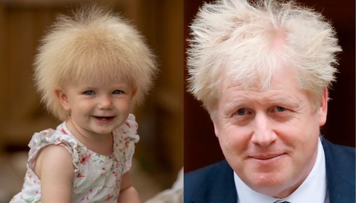 Baby Layla with Uncombable Hair Syndrome (l), Boris Johnson (r).— JOHN McLELLAN via The Sun, AFP