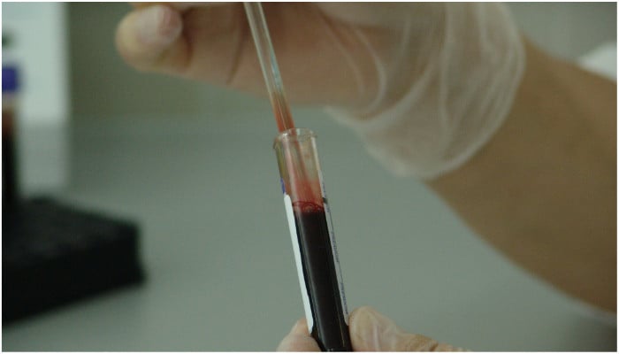 New blood test can diagnose cancer before symptoms show - Vimarsana News