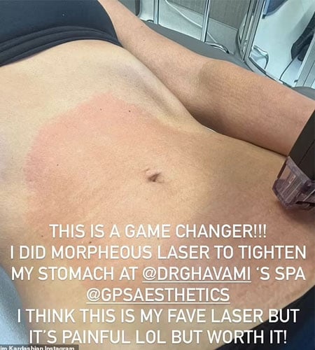 Kim Kardashian shares results of painful stomach laser procedure