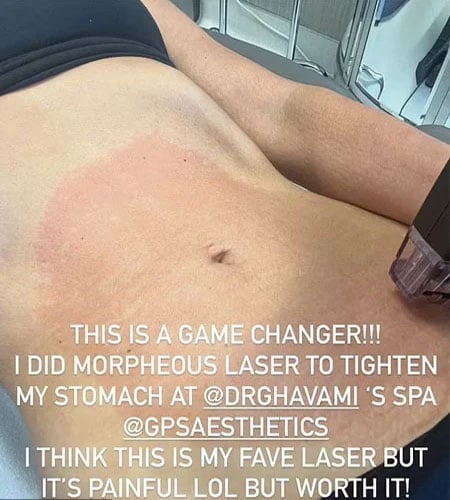 Kim Kardashian bashed over latest stomach tightening procedure: ‘Ugly visual’