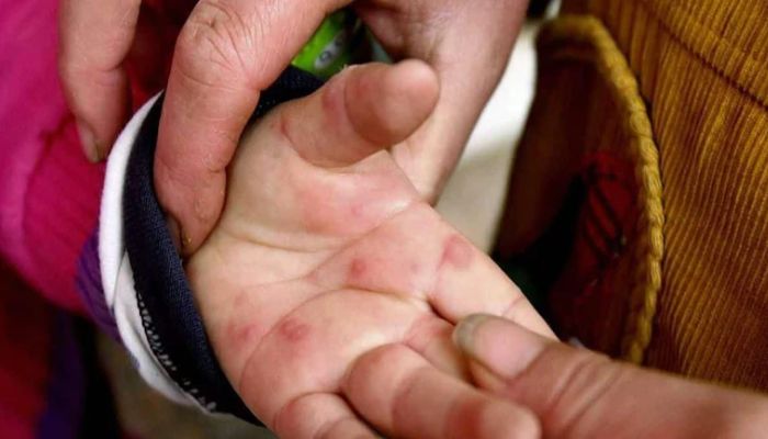 Pakar medis di India memerangi infeksi baru — Flu tomat