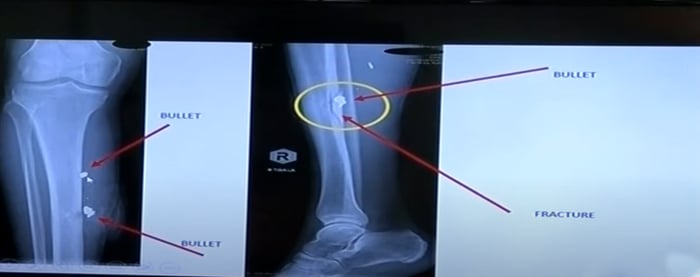 Image showing an X-ray of Khans shin. — Screengrab via YouTube/ Geo News Live