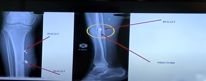 Imagen que muestra una radiografía de la espinilla de Khan.  — Captura de pantalla a través de YouTube/Geo News Live