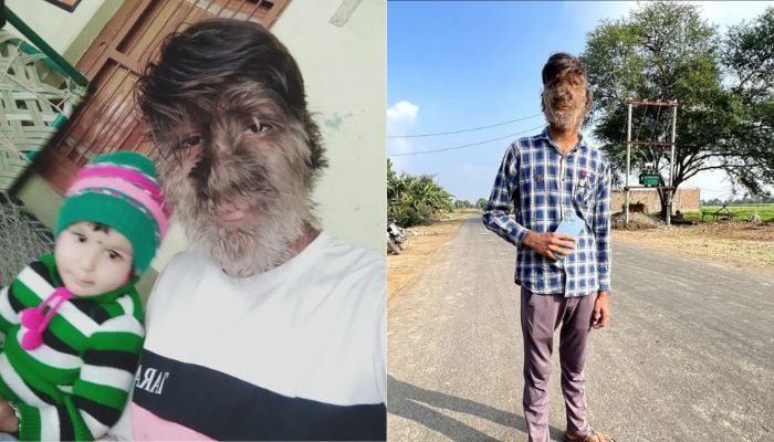 Lalit Patidar, 17, has hypertrichosis.— Instagram