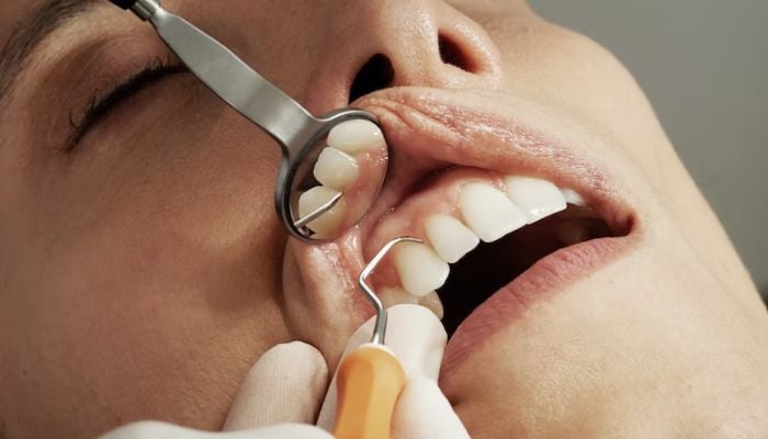 Kasus global penyakit mulut telah meningkat sebesar 1 miliar selama 30 tahun terakhir.— Unsplash