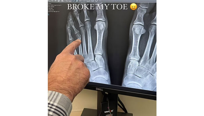 Travis Barker sparks concern after suffering toe injury