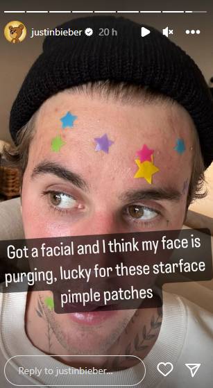 Justin Bieber gives a peek into post-facial skin ‘purging’: Photo