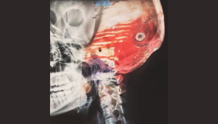 (Representational) Although oral abscesses caused by bacteria in the mouth are rare, they can be fatal if untreated.— Unsplash