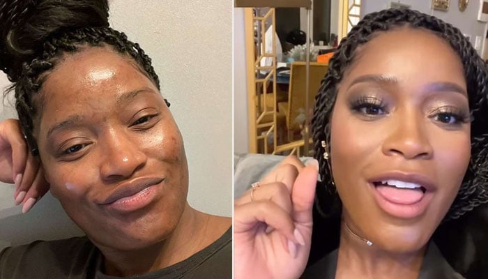 Keke Palmer discovers acne solution: I found the secret