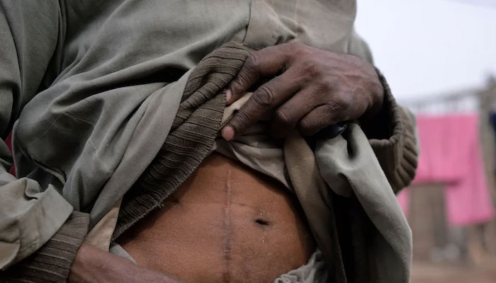 In this file photo, a man who sold one of his kidneys, displays a scar in Bhalwal in Sargodha District. — AFP