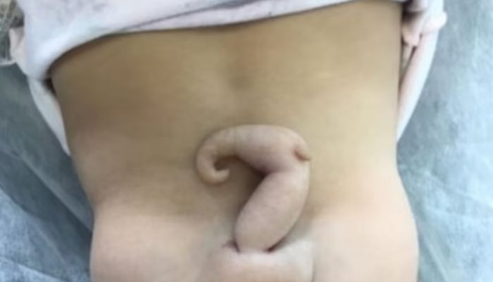 Woman who was born with '6cm tail' is now three years outdated