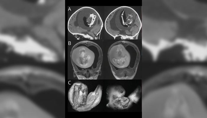 Ultrasound of the fetus developed in the one-year-old girl is shown in this picture. — American Academy of Neurology