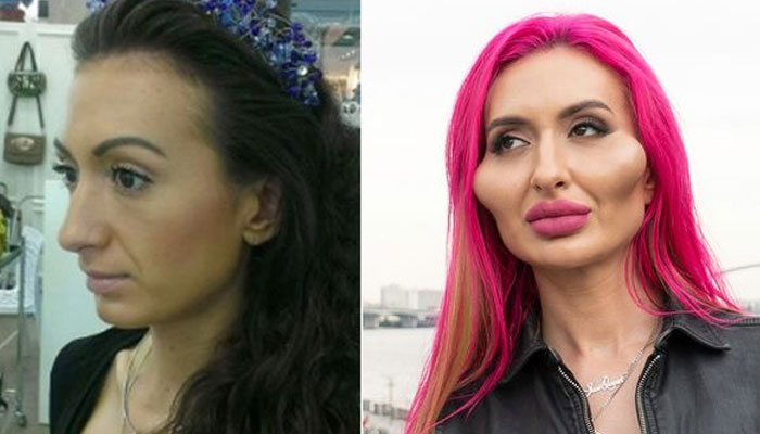 Ukrainian model Anastasia Pokreshchuk’s pre and after surgery photos. The Mirror