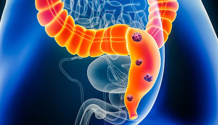 A representational image of human organs showing colon cancer glands. — Unsplash/File