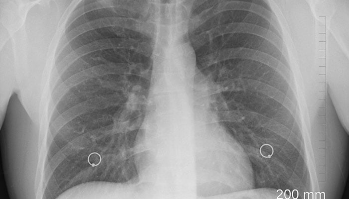 A representational image of a human X-ray. — Pixabay/File
