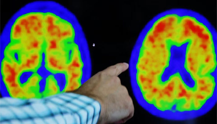 Dr Seth Gale points out evidence of Alzheimer’s disease on PET scans at the Center for Alzheimer Research and Treatment (CART) at Brigham And Women’s Hospital in Boston, US. — Reuters/File