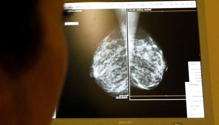 A doctor examines mammograms, a special type of X-ray of the breasts, which is used to detect tumours as part of a regular cancer prevention medical check-up at a clinic in Nice, southeastern France. — Reuters/File