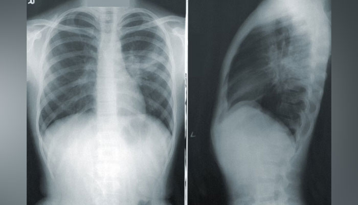 A representational image of a human X-ray showing the human chest and side ribs. — Unsplash/File