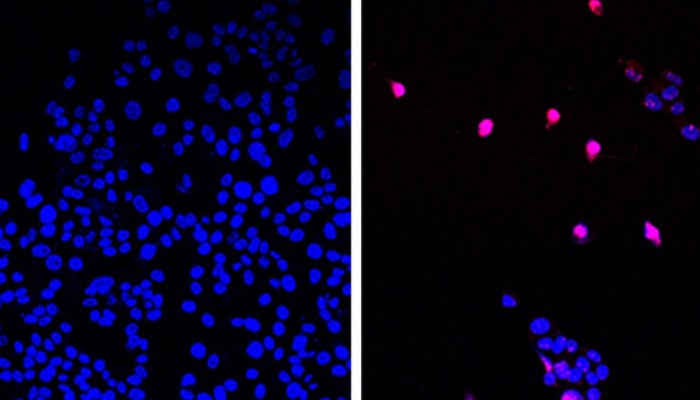 Untreated cancer cells are on the left, while cells treated with the new drug can be seen on the right. — City of Hope