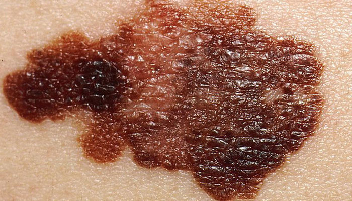 This illustration image shows a patch of skin stricken with melanoma skin cancer. — Derm net/File
