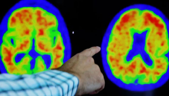 Dr Seth Gale points out evidence of Alzheimers disease on PET scans at the Center for Alzheimer Research and Treatment (CART) at Brigham And Womens Hospital in Boston, Massachusetts, US, March 30, 2023.-Reuters