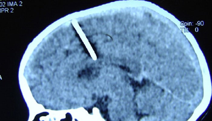 Cranial CT scan showing the sewing needle in the brain.—research gate/file
