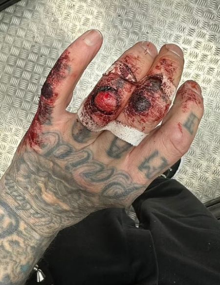 Travis Barkers drumming takes a bloody toll: Pic