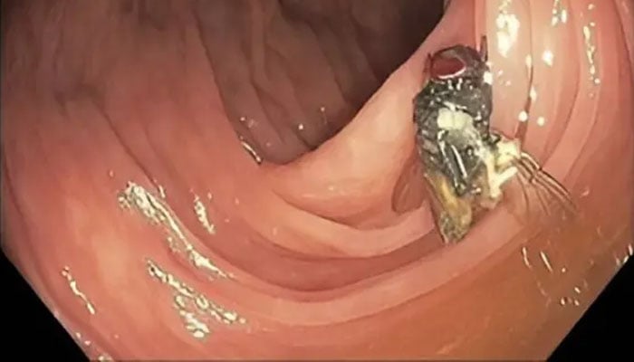 Colonoscopy footage of the fly.—American Journal of Gastroenterology