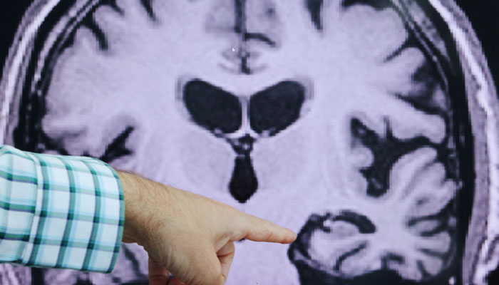 Extroverts navigate Alzheimers better than introverts – but it has a downside