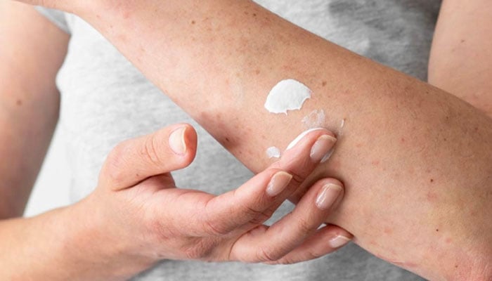 A woman applies moisturiser to the eczema on her arm. — Unsplash
