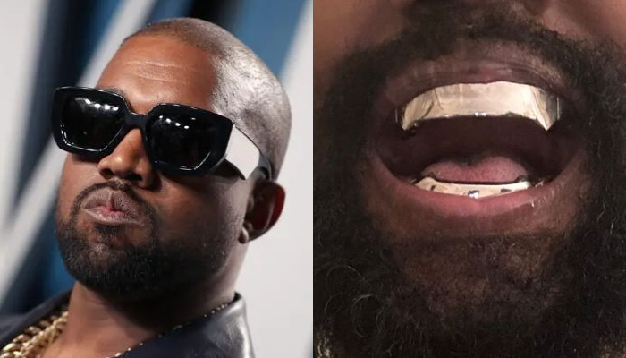 Kanye West’s new titanium dentures are reportedly causing oral health issues