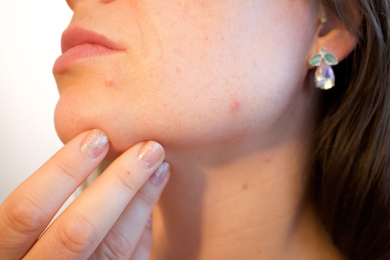 Tips to Remove Acne Scars at Home