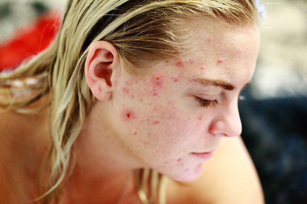 Top tips to Remove Acne Scars at Home