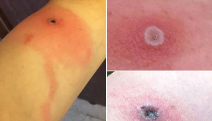 An Alaskapox lesion about 10 days after symptom onset.—Alaska Department of Health