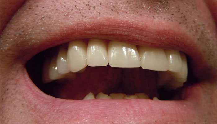 This image shows the stained teeth of an individual. — Pixabay