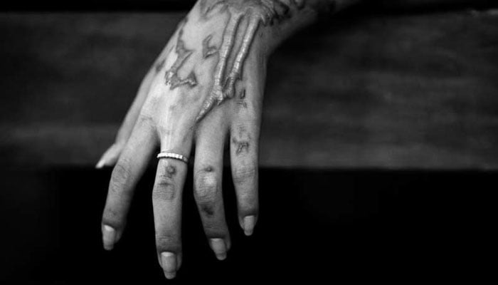 An acid attack survivor shows burn scars on her hand. — Reuters/File