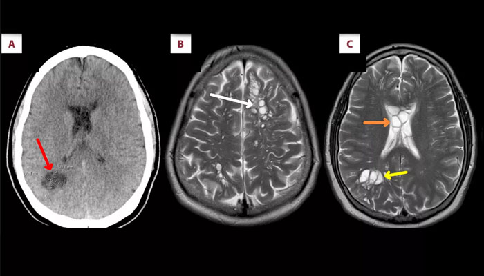 This image shows scans from the Florida man who had worm eggs in his brain. — People via American Journal of Case