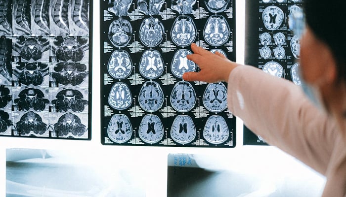A representational image of a healthcare professional pointing toward a series of brain scans. — Pexels