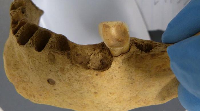 Bronze age dental discovery unveils origins of cavities and gum disease - Vimarsana News