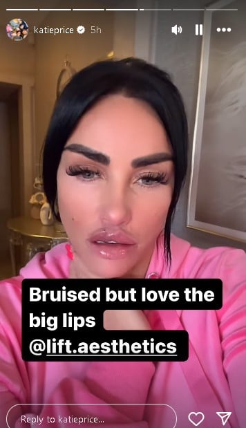 Katie Price gets extra big lips amid advocating against cosmetic surgery